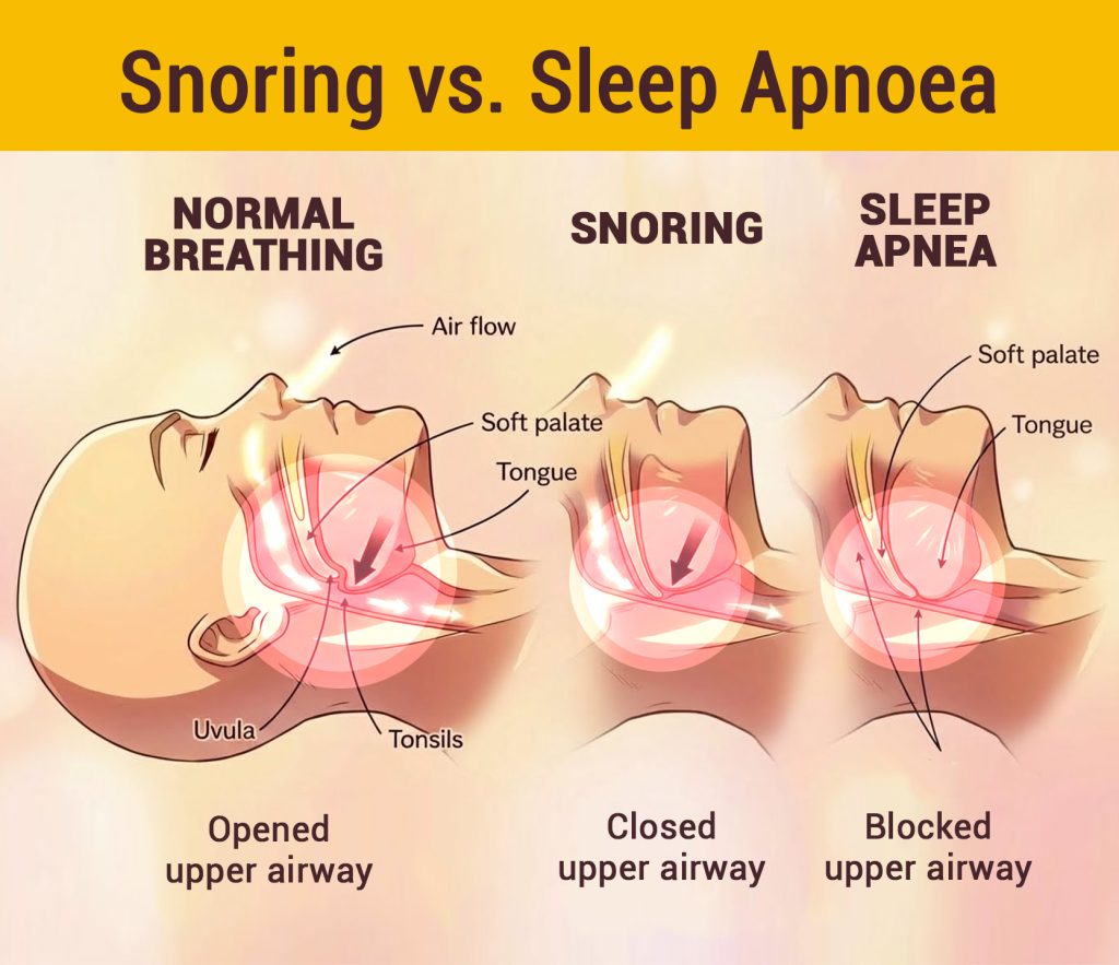 ENT Surgeons Medical Centre - Snoring vs Sleep Apnoea